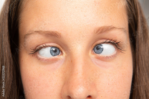Woman eyes suffering from strabismus photo