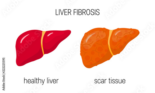 Liver fibrosis vector concept
