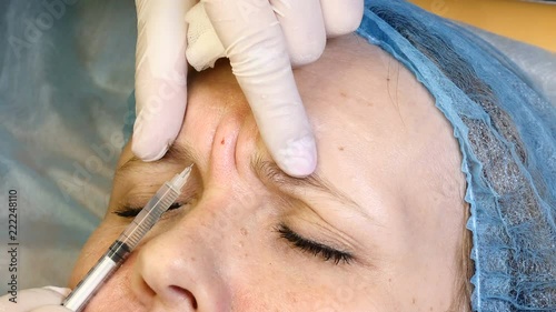 Face skin lifting injections. Beautician making botox injections. glabellar frown line care. Female face rejuvenation. 4k