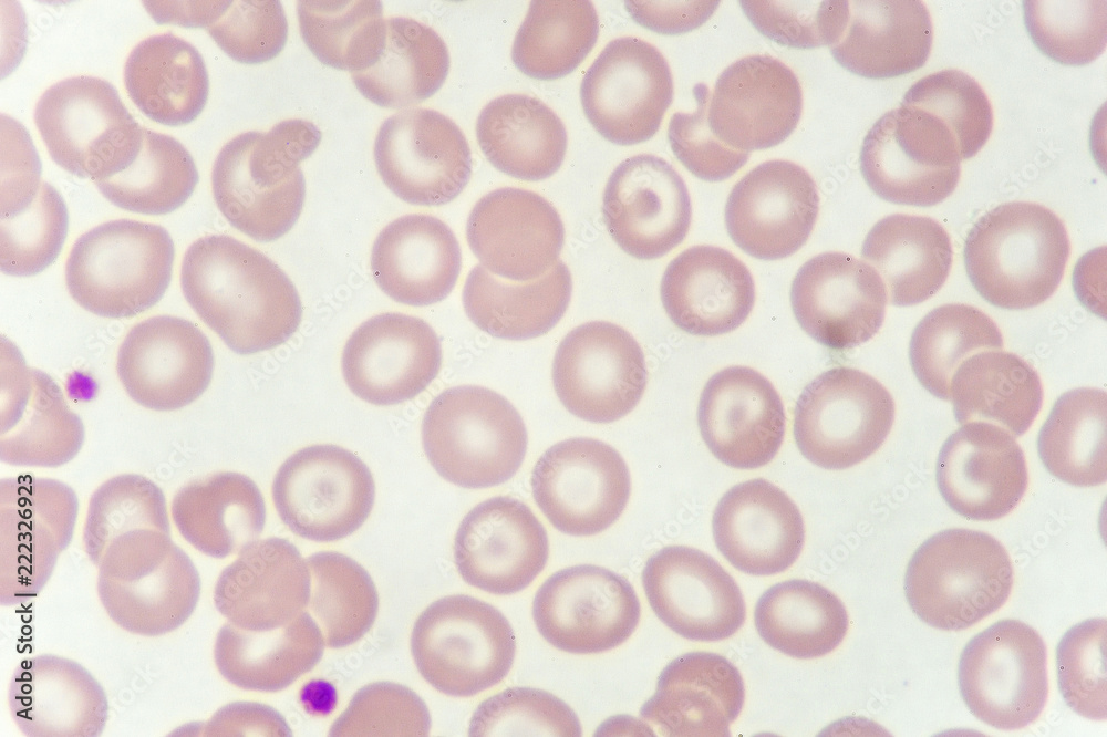 Target cells with abnormal red blood cells from anemia patient, analyze by microscope
