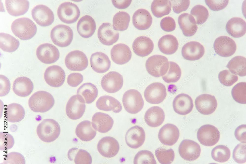 Target cells with abnormal red blood cells from anemia patient, analyze by microscope
