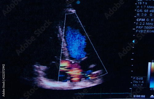 Color image of the ultrasound examination result. Made in an Ultrasound Machine. Human heart. Inter auricular communication (CIA) photo