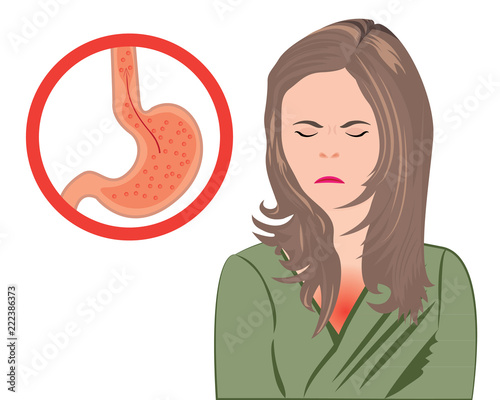 Gastroesophageal reflux desease. Gerd stomach in a human body vector illustration