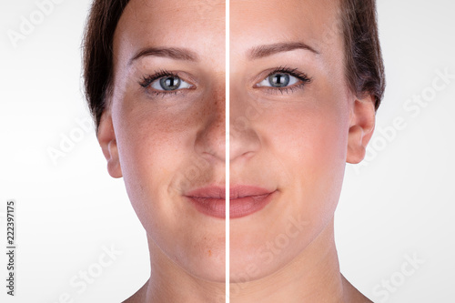 Woman's Face Before And After Cosmetic Procedure photo