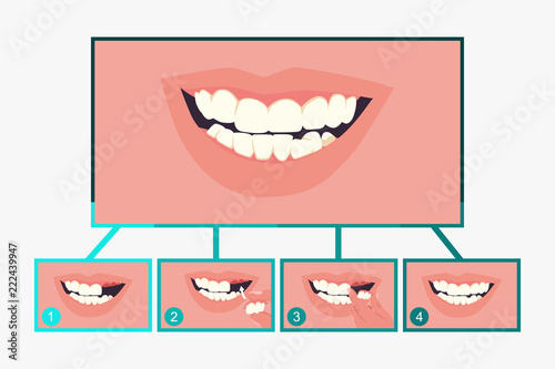 Partial denture dental. Stages of treatment. Vector flat stomatology infographics isolated on a white background.