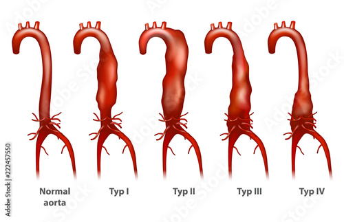 Abdominal aortic aneurysm (Thoracoabdominal). Crawford classification. 