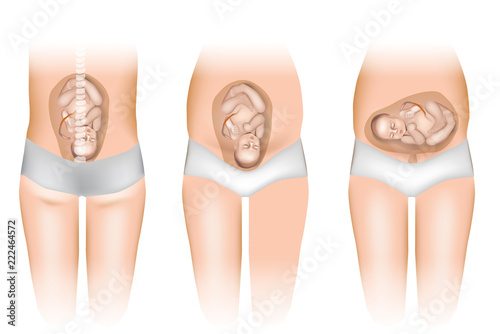 Pregnancy - Different Positions of Baby in the Womb. Fetus Positions In Uterus