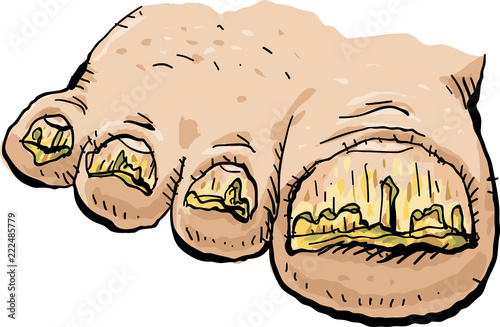 An illustration of a cartoon foot with toenails infected by foot fungus.