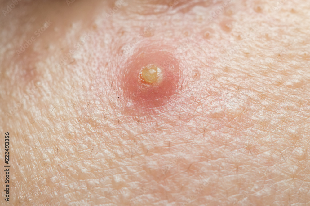 Fototapeta premium Close Up acne on the skin.