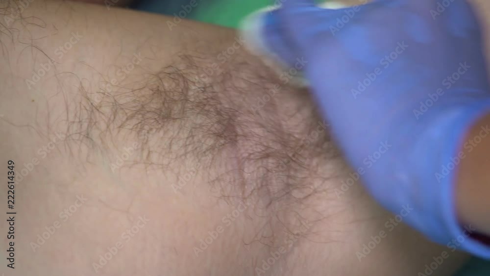 Beautician in Gloves Sterilizing Male Armpit before Sugaring Epilaion Procedure