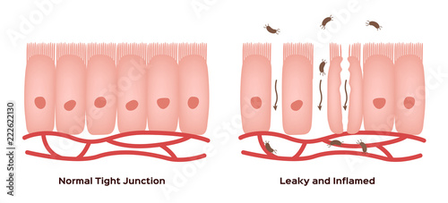 Celiac disease Small intestine lining damage. good and damaged villi . leaky gut progression photo