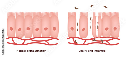 Celiac disease Small intestine lining damage. good and damaged villi . leaky gut progression