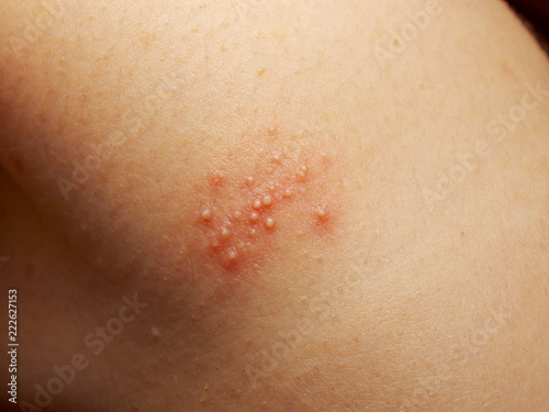 Close up of girl has rash and other nonspecific skin eruption on her shoulders. May be caused by dirt, virus, mold, or bacteria. The doctor is currently diagnosed