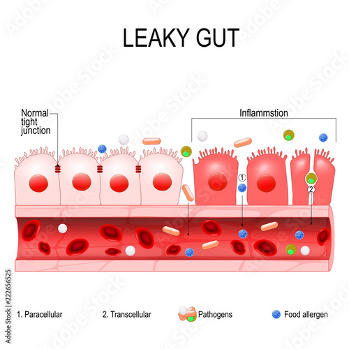 leaky gut photo