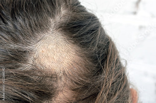 Foto Mycosis of the scalp