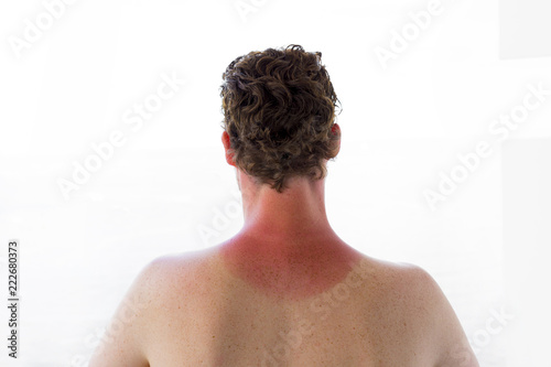 Quadro em tela Close up of young man with a sunburn isolated on white background