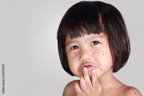 Tablou pe pânză Little Girl With Smallpox