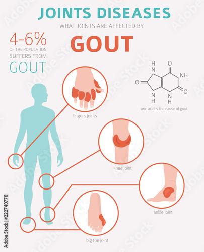 Joints diseases. Gout symptoms, treatment icon set. Medical infographic design