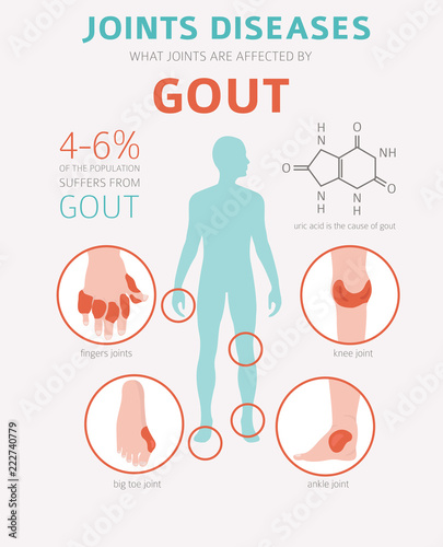 Joints diseases. Gout symptoms, treatment icon set. Medical infographic design