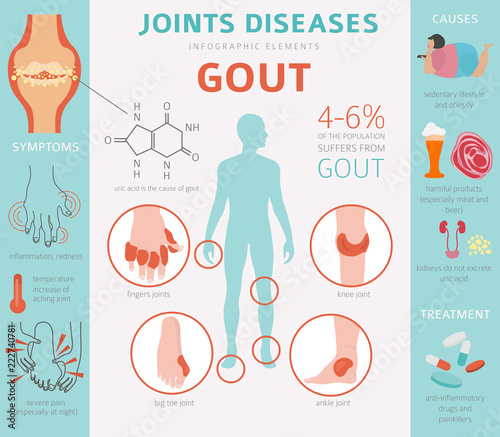 Joints diseases. Gout symptoms, treatment icon set. Medical infographic design