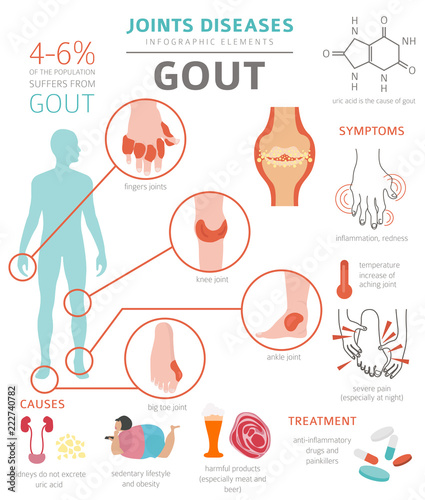 Joints diseases. Gout symptoms, treatment icon set. Medical infographic design