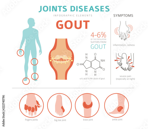 Joints diseases. Gout symptoms, treatment icon set. Medical infographic design photo