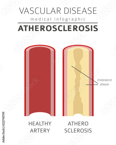 Vascular diseases. Atherosclerosis symptoms, treatment icon set. Medical infographic design