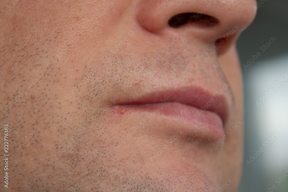 man lips virus infected herpes man lips virus infected herpes