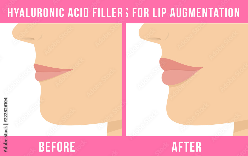 Obraz premium Woman makes procedure of beauty injection for lip augmentation. Lips before and after hyaluronic acid lip filler injection. Vector