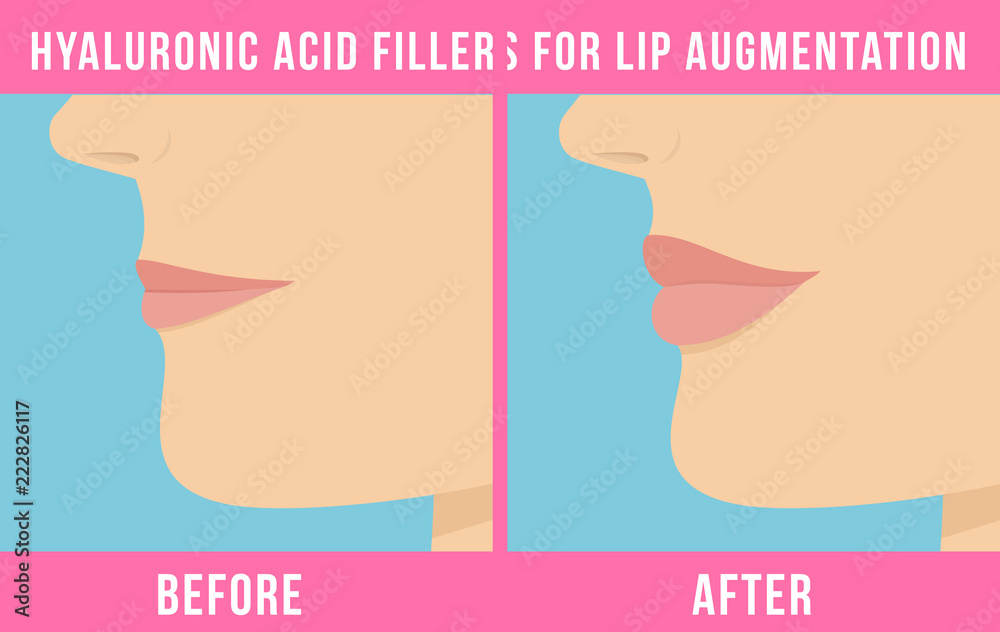 Woman makes procedure of beauty injection for lip augmentation. Lips ...