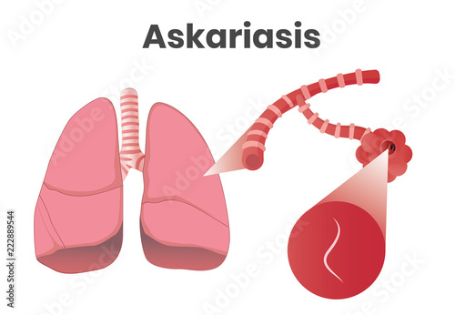 Askaris disease. Vector illustration of the larvae in lungs photo