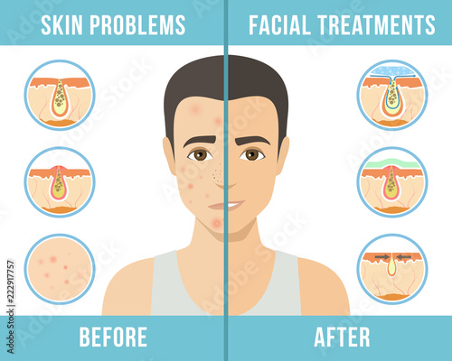 Man with a problem skin. Treatment of acne, skin care, men s cosmetics. Vector