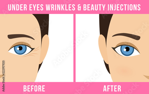 Women anti-aging skin care. Different types of facial wrinkles. Woman before and after Botox injection. Anti-aging procedure. Vector