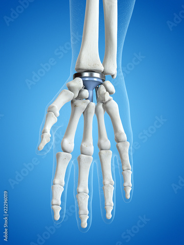 3d rendered medically accurate illustration of a wrist replacement photo