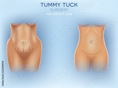 Female body correction before and after surgery and weight loss colorful illustration on a light blue background