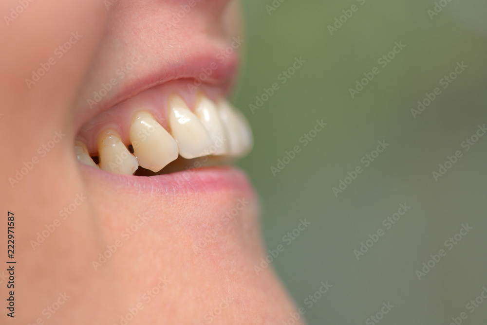 Woman teeth parodontose