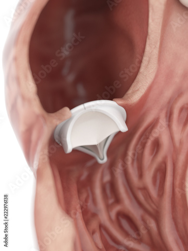 3d rendered medically accurate illustration of an artificial heart valve
