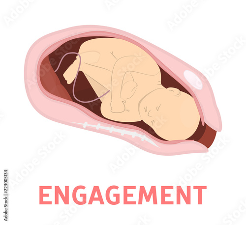 Engagement stage of baby birth in vaginal delivery