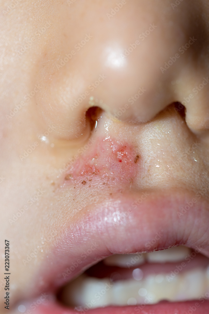 Fototapeta premium Wound on the child's face