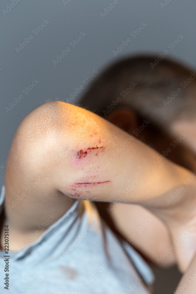 Fototapeta premium The wound on the child's arm
