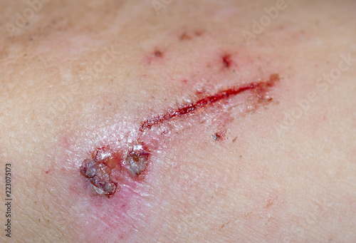 Φωτογραφία Wound on the skin of a macro