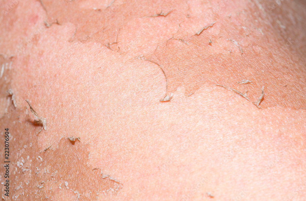 Fototapeta premium burned skin macro