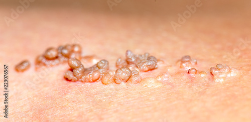 birthmark on the skin of a macro