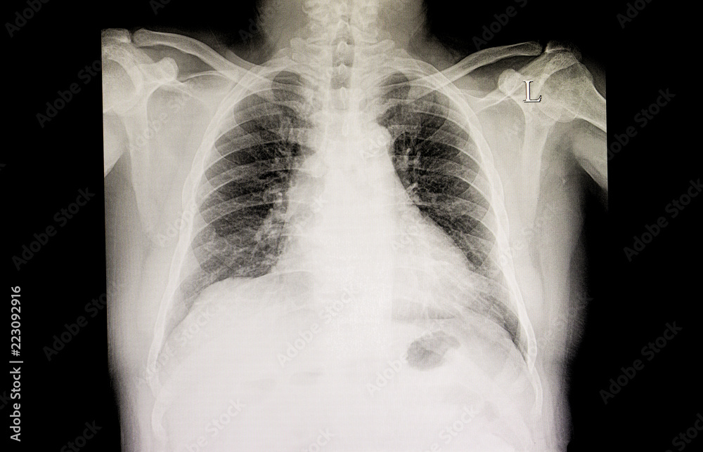 cardiomegaly and congestive heart failure cardiomegaly and congestive heart failure