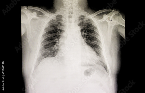 cardiomegaly and congestive heart failure