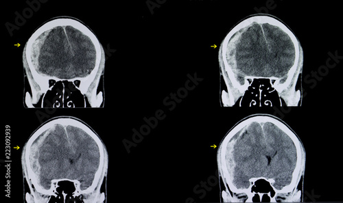 brain subarachnoid hemorrhage
