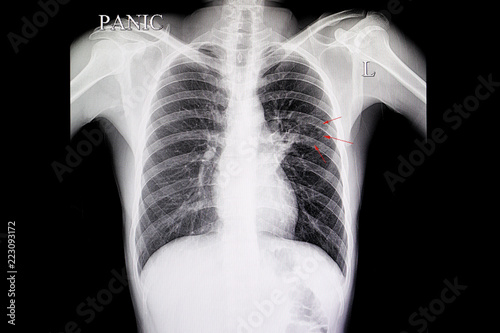 Pulmonary Tuberculosis photo