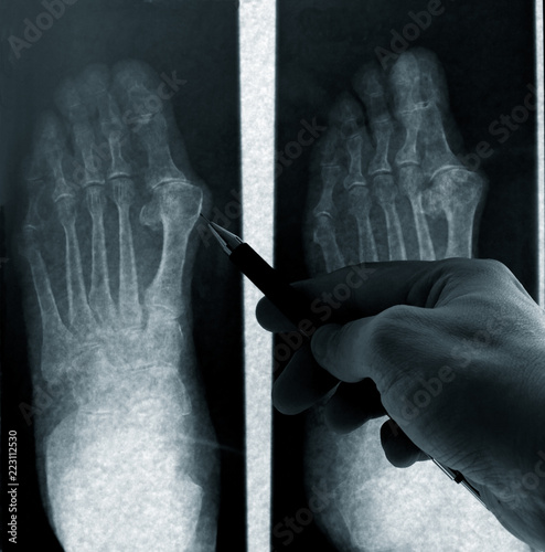  specialist doctor anayzes foot radiography at x-ray film viewer photo