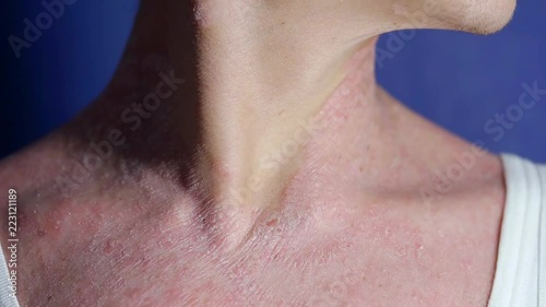 sick man with psoriasis is scratching his dry itchy skin on neck, close-up view photo