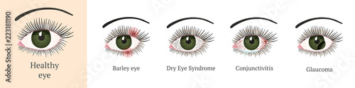 Most common eye problems  photo